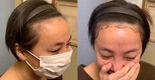 이에 미르는 조만간 고은아 머리 심으니 기대해달라라며 크게 웃었다. ë°°ìš° ê³ ì€ì•„ ë¨¸ë¦¬ ìƒíƒœ ê³µê°œ ëª¨ë°œì´ì‹ ê²°ì • ì´ì§€ì¼ë³´