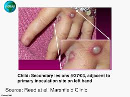 Et a case of monkeypox, a rare but potentially serious viral illness, has been identified in a texas resident who recently returned from nigeria, health officials said on. Ppt Monkeypox Outbreak In The Us Powerpoint Presentation Free Download Id 507128