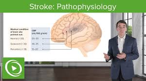 Image result for Stroke Pathophysiology