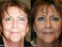 When to see a doctor about a swollen eyelid Ted Graves Disease Toc Eye And Face