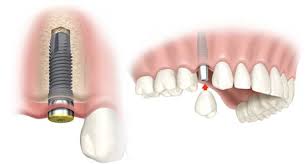 Platnya relatif lebih tebal dan ada cengkeram kawatnya sebagai tambahan pegangan ke gigi yang tersisa. Ini Harga Pasang Gigi Palsu Yang Kamu Butuhkan Audy Dental