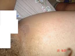 Sur un côté, j'ai une petite lèvre qui gratte énormément et qui enfle beaucoup lorsque je la gratte.image schématique d'ou c'est enflé: Probleme Depuis Un Mois Grosse Tache Qui Gratte Regles Et Problemes Gynecologiques Forum Sante Doctissimo