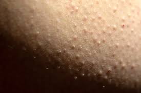 Image result for Keratosis pilaris