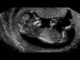 معرفة نوع الجنين عن طريق اتجاه الرأس والقدم فى صورة السونار youtube