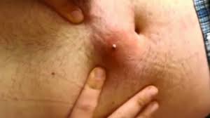 Try washing the area with soap and water and exfoliating the area with. This Massive Ingrown Hair Will Make Your Stomach Turn Ouch Video