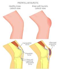 Image result for Bursitis