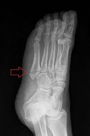 Image result for Metatarsal