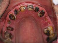 A lot of people are asking why someone would need a full mouth extraction (fme) like this. An Efficient Approach To Full Mouth Extractions Dentistry Today