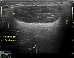 Parotid Lipoma Radiology Case Radiopaedia Org Parotid Gland Gland Cancerous Moles