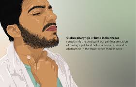 A throat cancer lump is usually firm. Globus Pharyngis Wikipedia