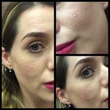 makeup forever hd foundation acne