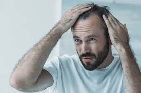 Over years, pcos may slowly result in excess hair growth, irregular periods, obesity, infertility and sometimes multiple cysts on the ovaries. 6 Common Hair Loss Causes In Men Man Of Many