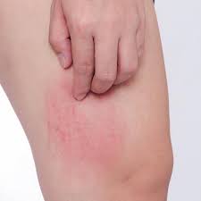Por Que Me Pican Las Piernas Por La Noche Descubrelo