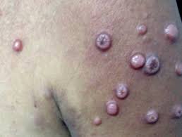Primary cutaneous follicle center Lymphoma-Types-Causes-Symptoms-Diagnosis-Allopathic and Homeopathic Treatment-Dr. Qaisar Ahmed