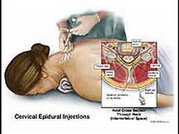 Image result for Lower Cervical Intramuscular Injection