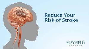 Numbness can occur along a single nerve on one side of the body, or it may occur symmetrically, on both sides of the body. Stroke Mayfield Brain Spine Cincinnati Ohio