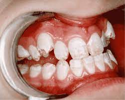 Fluoride Action Network Moderate Severe Dental Fluorosis
