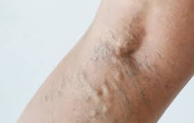 Varicose veins typically appear swollen and raised, and have a. If You Have Varicose Veins You Re Probably Making This Huge Mistake Prevention