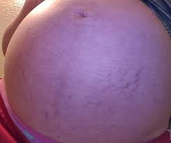 Red Stretch Marks Babycenter