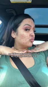 Full Coveage Foundation Summer Makeup Routine Hyperpigmentation