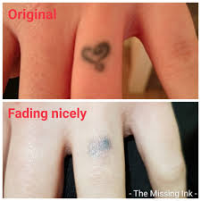 Laser works by repeatedly targeting the ink with pulses of highly concentrated light, which breaks the ink into tiny fragments that are then naturally removed by your body. Finger Tattoos Are The Missing Ink Laser Tattoo Removal Facebook