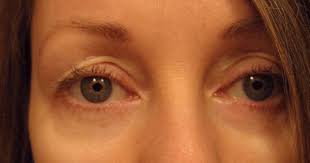 Chemical Peels For Acne And Anti Aging Hooded Saggy Droopy Eyelids Chemical Peel Natural Aging Skin Care Chemical Peel Acne