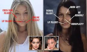 However, not everyone is convinced. Plastic Surgeons Reveal What Procedures Bella And Gigi Hadid May Have Undergone Daily Mail Online