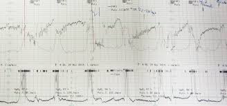 Ab wann und wie häufig ein ctg gemacht wird, hängt grundsätzlich vom verlauf der schwangerschaft ab. Mein Geburtsbericht Mama Und Rakete