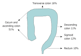 Sessile Serrated Adenomas Demographic Endoscopic And