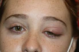 Image result for Dacryoadenitis
