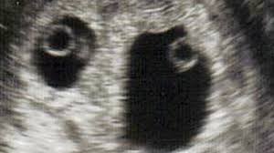 Wie erkennt man eine zwillingsschwangerschaft? Zwillinge In Der 7 Woche Ssw6 Babywelten Ch