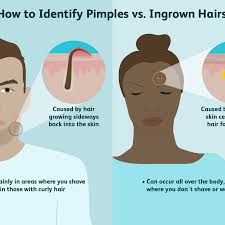 An ingrown hair cyst can be deep and painful in areas with hair such as the bikinis, thighs, neck, face and armpits. Difference Between A Pimple And An Ingrown Hair