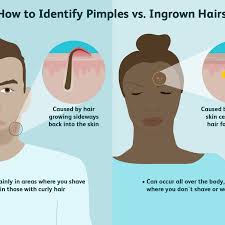 This procedure is best used when treating one acne nodule or cyst and is not recommended for the treatment of multiple acne blemishes, as corticosteroid injections should be used sparingly. Difference Between A Pimple And An Ingrown Hair