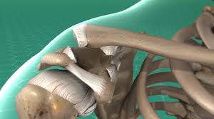 Operation Der Schultereckgelenks Arthrose Gelenk Klinik De