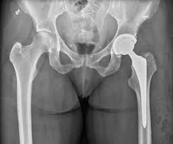 Pain is the most typical sign of bone cancer, and might end up being more obvious as the tumor grows. Hip Replacement Wikipedia