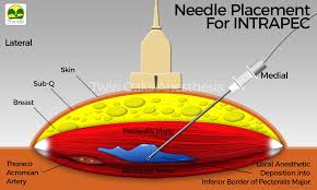 Image result for Intrapleural Anesthesia