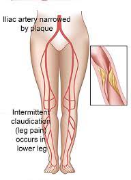 Aortoiliac Occlusive Disease Conditions And Treatments La Vascular Endovascular Surgery
