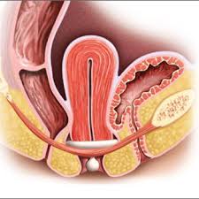 Pessaries For Vaginal Prolapse Critical Factors To