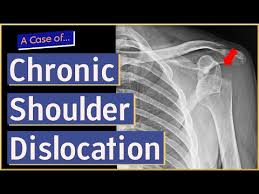 Image result for Chronic Shoulder Dislocation