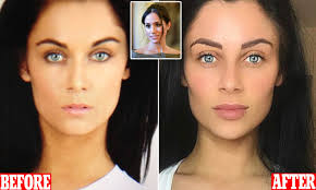Dr Esho Lip Fillers How Women Are Opting For Natural Meghan Markle Inspired Lips Daily Mail Online