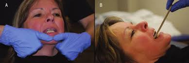 A Proposed Diagnostic Classification of Patients With Temporomandibular  Disorders: Implications for Physical Therapists