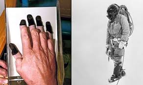 A surgeon amputated everything and I was as good as new: Major Bronco