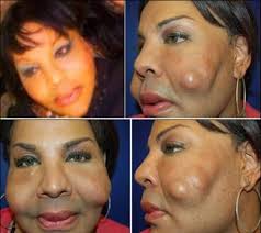 صور مفزعة لأفشل عمليات التجميل على مستوى العالم - بوابة الشروق - نسخة  الموبايل