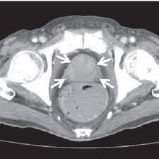 Although screenings for prostate cancer are one tool for early detecti. Pelvic Ct Showing A Remarkably Enlarged Prostate With Heterogeneous Download Scientific Diagram