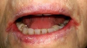 Become the first person to post messages in this. What Is Plummer Vinson Syndrome Stanford Medicine 25 Stanford Medicine