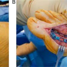 J foot ankle surg 2013; Pdf Complication Rates In Diabetics With First Metatarsophalangeal Joint Arthrodesis