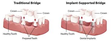 Check spelling or type a new query. Dental Bridges Fara Dental
