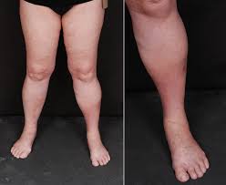 Oxandrolona no tratamento da lipodermatoesclerose: relato de caso