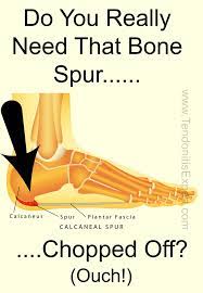 Pin On Tendonitis Info