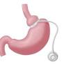 bariatric surgery from www.nhs.uk